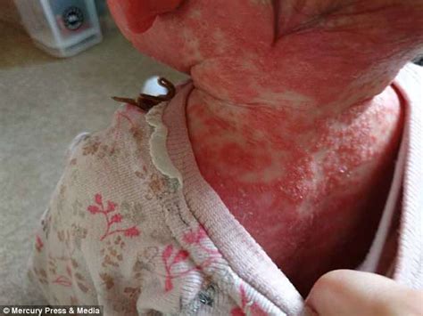 Toddlers Psoriasis Is So Bad It Makes Her Look Like A Little Crab