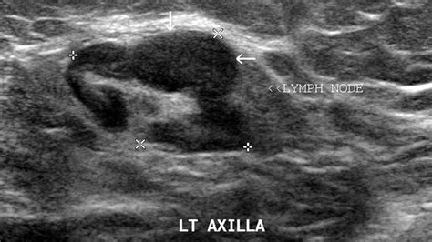 Axillary Ultrasound Video Image Breast Cancer School For Patients