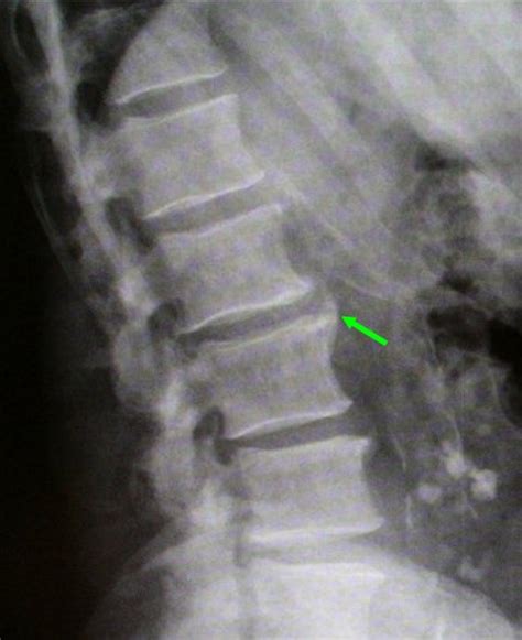 Lumbar Spine Arthritis In Lumbar Spine
