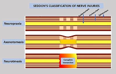 This type of nerve injury requires regrowth of the axon to the target muscle, which takes a considerable amount of time. Peripheral nerve injury classification - Wikipedia
