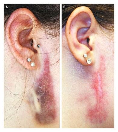 This cartilage is a bit thick and ideal for piercing. Medical Pictures Info - Piercing Infection