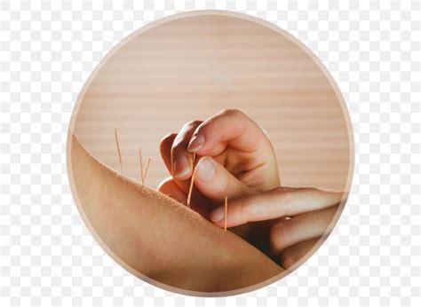 dry needling myofascial trigger point acupuncture myotherapy myofascial release png 600x600px
