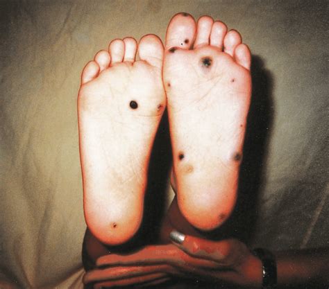 Albums Wallpaper Pictures Of Dark Spots On Bottom Of Feet That Are Related To Diseases Completed