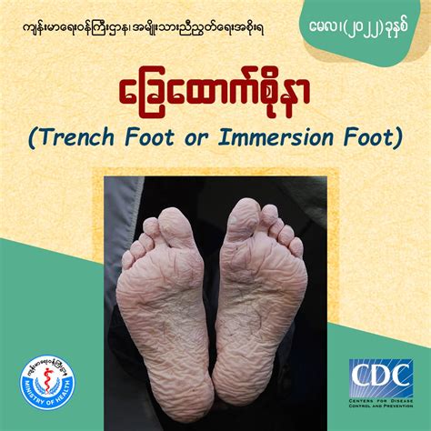 ခြေထောက်စိုနာရောဂါ Trench Foot Or Immersion Foot Ministry Of Health Moh Myanmar