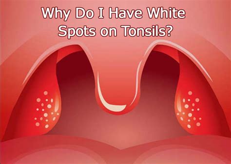 White Spots On Tonsils With Pus Swollen No Fever Pain Strep