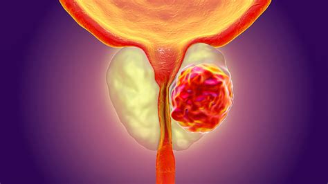 Prostate cancer occurs when abnormal cells develop in the prostate. Enzalutamide + ADT Boosts Outcomes in Advanced Prostate Cancer