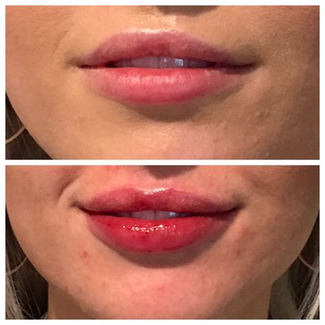 Lip Filler After Care Delle Chiaie Cosmetic Medicine