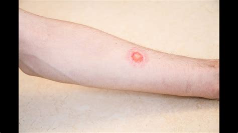 Is It Ringworm Signs And Symptoms Health Newest