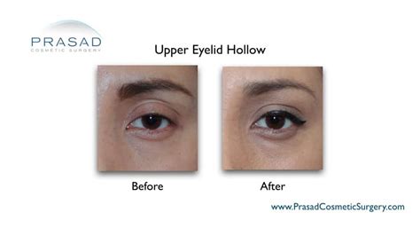 Upper Eyelid Filler Before And After Photos New York