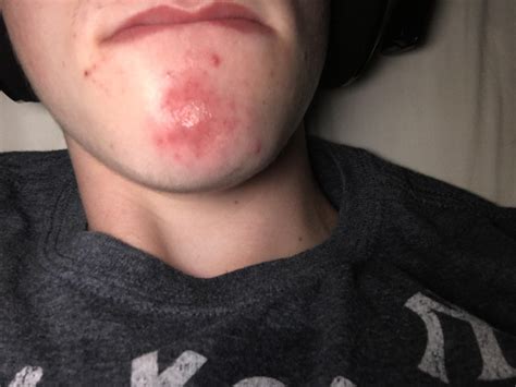 Red Spots On Chin