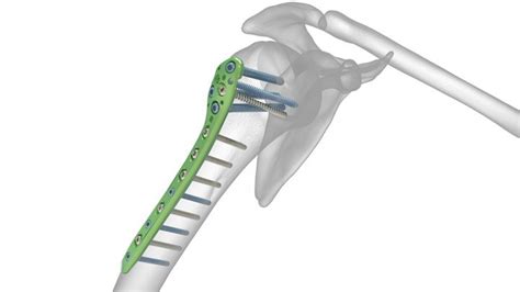 Fractura Epifizacap Proximala Humerus Consultatie Ortopedie