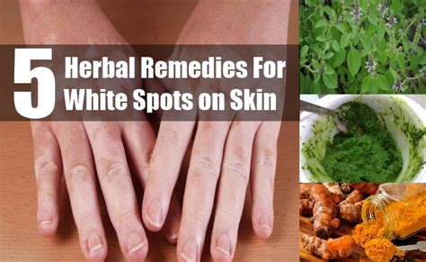 5 Herbal Remedies For White Spots On Skin Natural Treatment Search