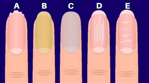Your Nails Say Everything About You And Your Health In Palmistry