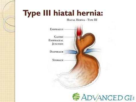 Ppt Endoscopic Diagnosis Of Hiatal Hernia Powerpoint Presentation