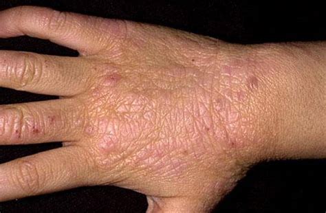 Atopic Dermatitis Eczema Skin Disorders