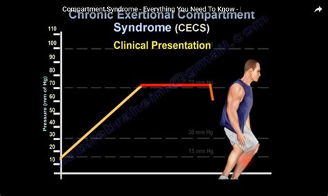 Chronic Exertional Compartment Syndrome —