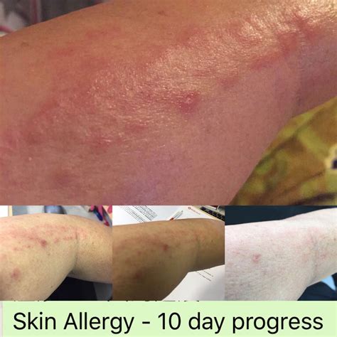Natural And Safe Way To Treat Skin Allergy Skin Allergies Treat Skin
