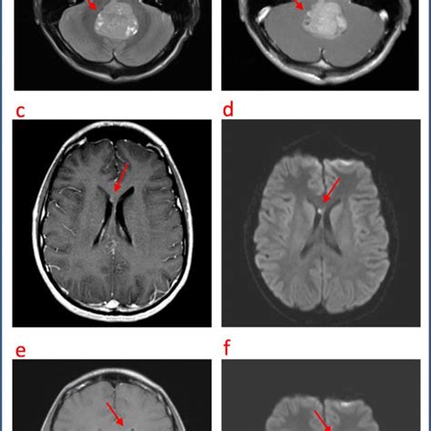 Patient Two Magnetic Resonance Imaging Mri At Initial Diagnosis A