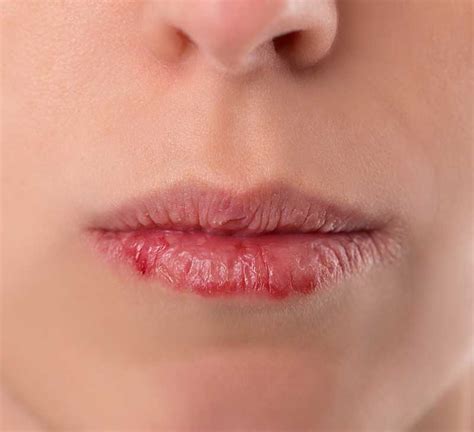 What Does Lip Cancer Look And Feel Like