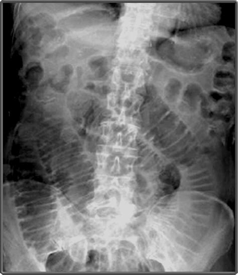 Clinical Anatomy Radiology Abdomen Intestines