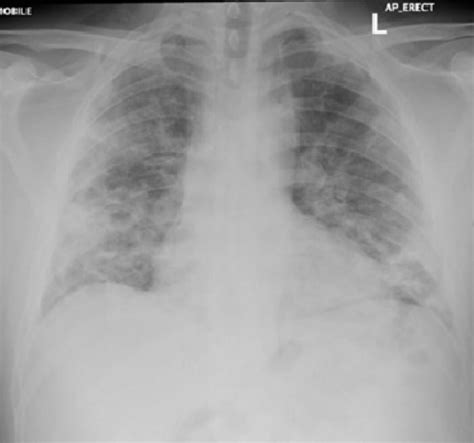 Pneumothorax vs tension pneumo (self.medicine). Tension pneumothorax in a patient with COVID-19 | BMJ Case ...