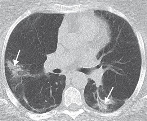 Interstitial Lung Disease Radiology Key