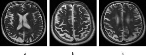 Neuroimaging Characteristics Of Cerebral Atrophy In Magnetic Resonance