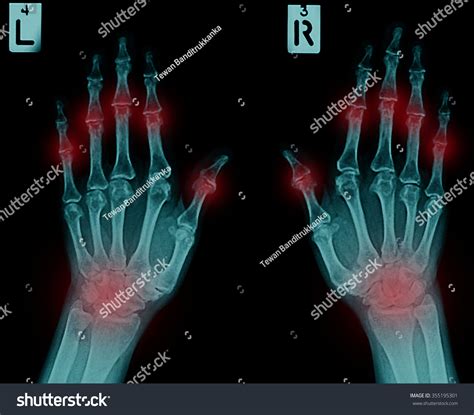 Film Xray Both Humans Hands Arthritis Stock Photo 355195301 Shutterstock