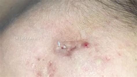 Big Deep Whiteheads And Sebaceous Cyst Removal Youtube