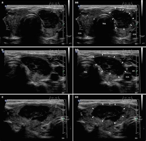 Other Malignancies In Thyroid Gland And Cervical Lymph Nodes