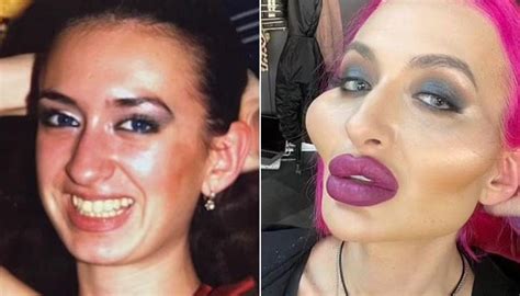 Ukrainian Woman Who Injected Herself With Filler To Get The Worlds