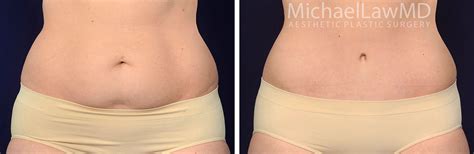 Belly Button Plug After Tummy Tuck Cosmetic Surgery Tips
