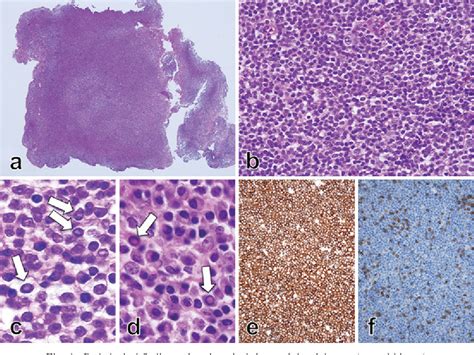 Figure 4 From A Definitive Diagnosis Of Mucosa Associated Lymphoid