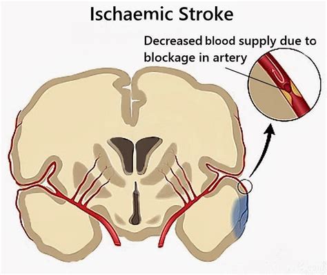 Ischemic Focal Ischemic Stroke