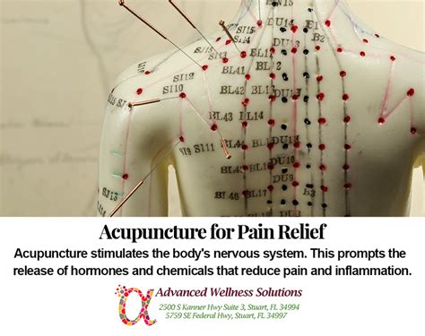 Acupuncture For Pain Relief Advanced Wellness Solutions