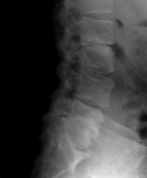 Lumbar Spine Degeneration The Bone School