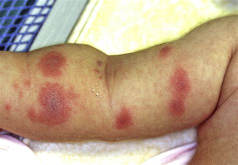 Erythematous Plaques In A Child With Sweet Syndrome The Journal Of