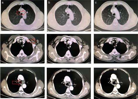 Case 2 A Before Treatment The Ct Scan Showed Left Lung Masses With