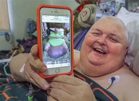 130 Pound Tumor Removed From Mississippi Man Who Was Told He Was Just Fat