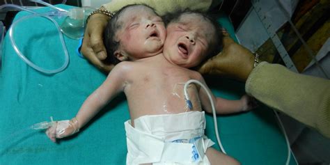 Female Baby Having Two Heads Born In India Huffpost