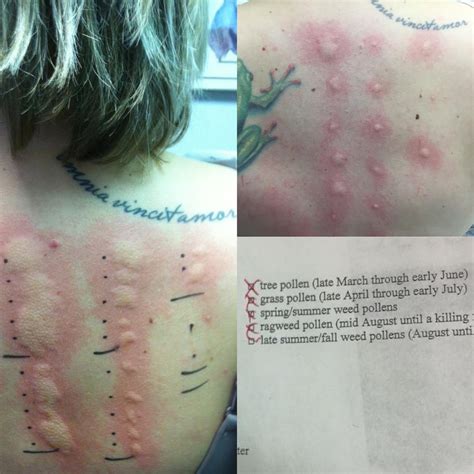 Allergy Scratch Tests Before Left And After Top Right A Year Of Immunotherapy Oc Medizzy
