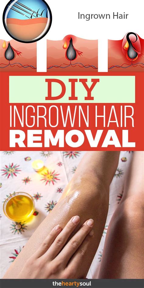 Ingrown Hair Removal Natural Remedy For Ingrown Hair With Essential Oil Ingrown Hair Ingrown