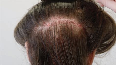 Implant Capillaire avec la Greffe de Cheveux sans Rasage à Lyon