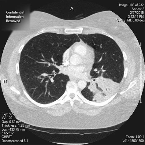 Lung Lobar Collapse As The First Manifestation Of Pulmonary Epithelioid
