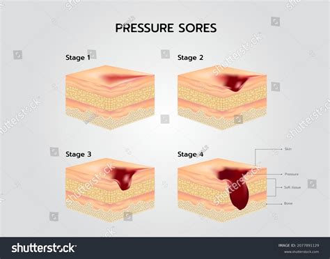 Bedsore Stages Pressure Sores Decubitus Ulcer Stock Vector Off