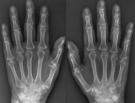 Rheumatoid arthritis (ra) is associated with reduced quality of life, decreased life expectancy, and has an adverse financial impact on the individual and society. Image: X-Ray Features of Early Rheumatoid Arthritis ...