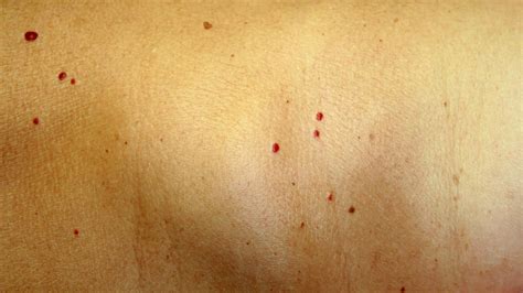 Cherry Angioma Symptoms Causes Treatment And Removal