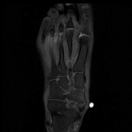 Accessory Navicular Syndrome Radiology Reference Article