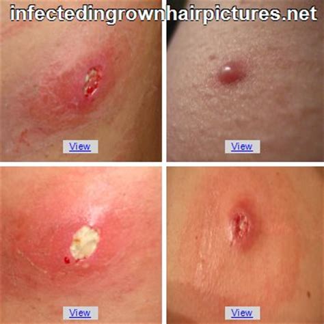 How to prevent infected ingrown pubic hair. Infected Ingrown Hairs