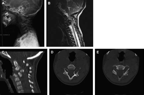 Congenital Anomalies Of The Cervical Spine Neurosurgery Clinics